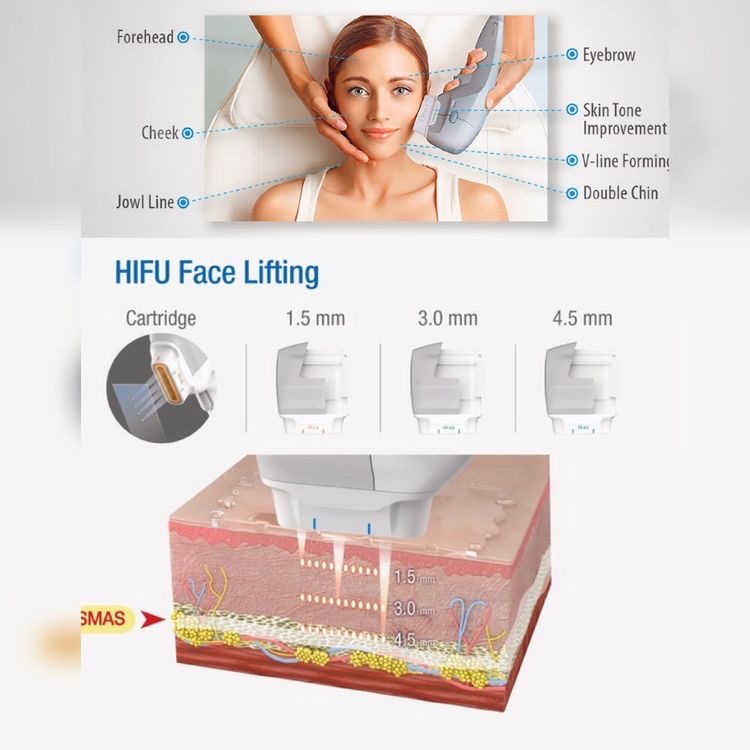 HIFU – tehnologia de lifting facial si tratament anti-age